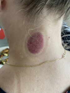 Cupping